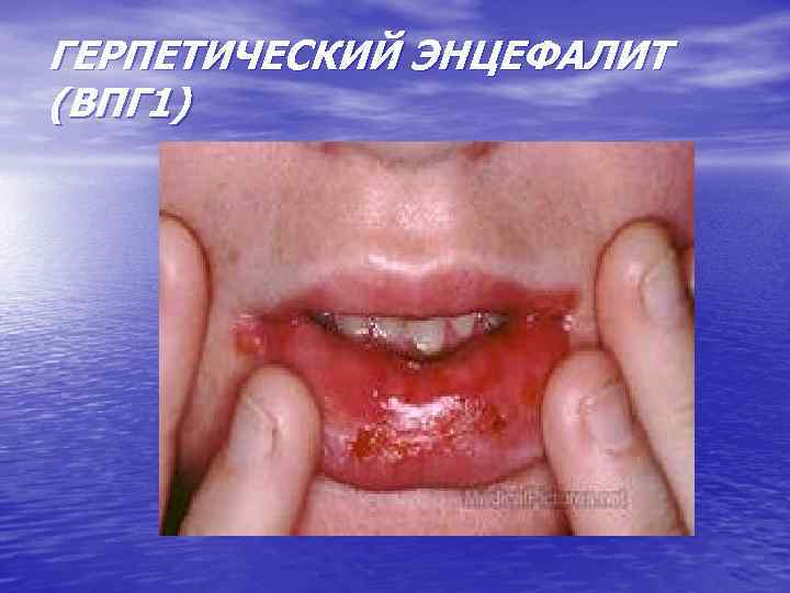 ГЕРПЕТИЧЕСКИЙ ЭНЦЕФАЛИТ (ВПГ 1) 