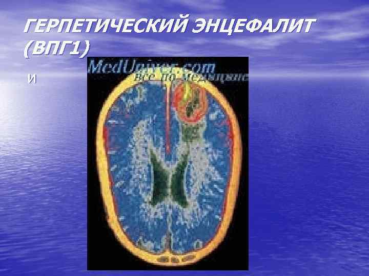 ГЕРПЕТИЧЕСКИЙ ЭНЦЕФАЛИТ (ВПГ 1) и 