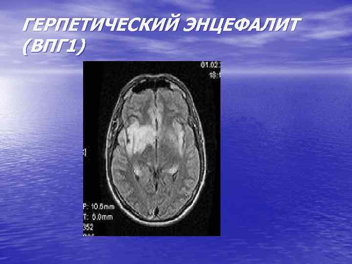 ГЕРПЕТИЧЕСКИЙ ЭНЦЕФАЛИТ (ВПГ 1) 