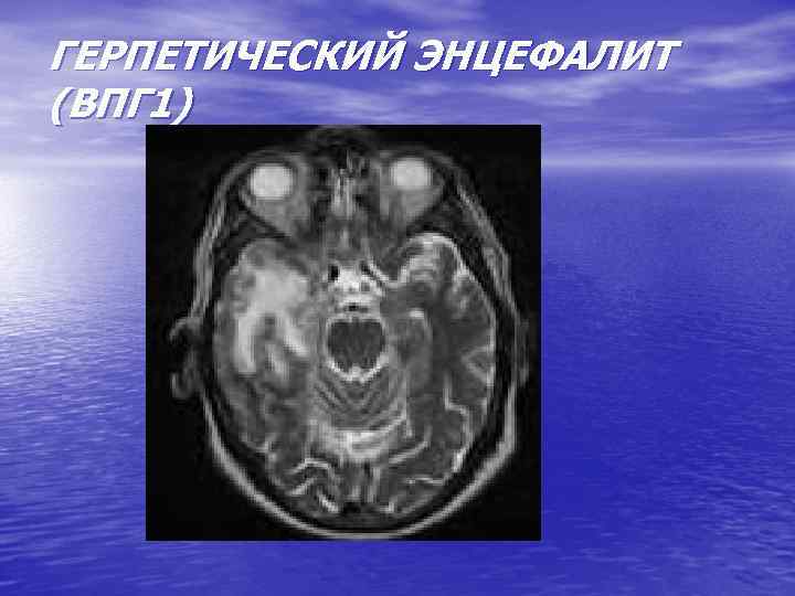 ГЕРПЕТИЧЕСКИЙ ЭНЦЕФАЛИТ (ВПГ 1) 