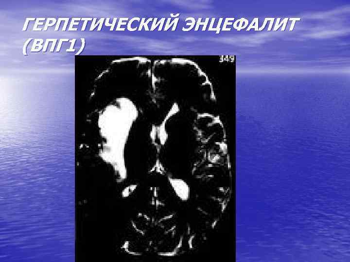 ГЕРПЕТИЧЕСКИЙ ЭНЦЕФАЛИТ (ВПГ 1) 