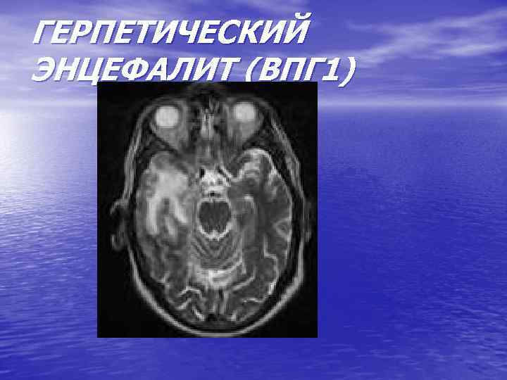 ГЕРПЕТИЧЕСКИЙ ЭНЦЕФАЛИТ (ВПГ 1) 