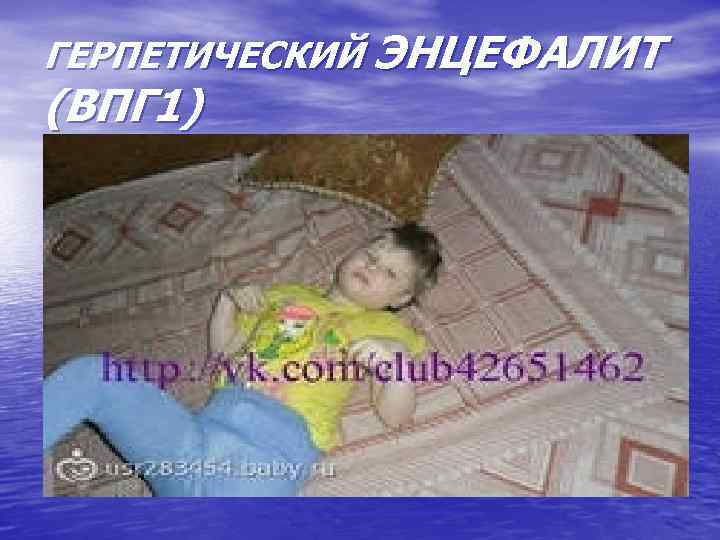 ГЕРПЕТИЧЕСКИЙ ЭНЦЕФАЛИТ (ВПГ 1) 