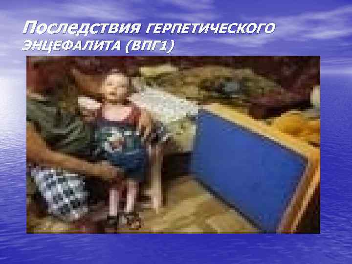 Последствия ГЕРПЕТИЧЕСКОГО ЭНЦЕФАЛИТА (ВПГ 1) 