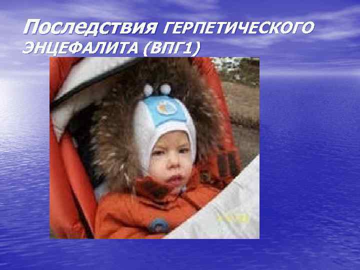 Последствия ГЕРПЕТИЧЕСКОГО ЭНЦЕФАЛИТА (ВПГ 1) 