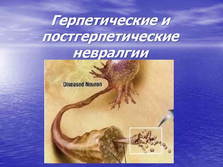 Герпетические и постгерпетические невралгии 