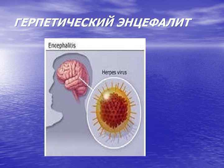 ГЕРПЕТИЧЕСКИЙ ЭНЦЕФАЛИТ 