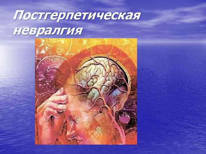 Постгерпетическая невралгия 