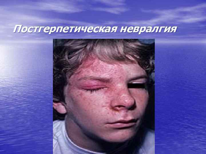 Постгерпетическая невралгия 