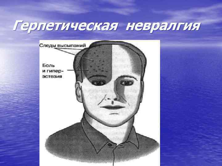 Герпетическая невралгия 