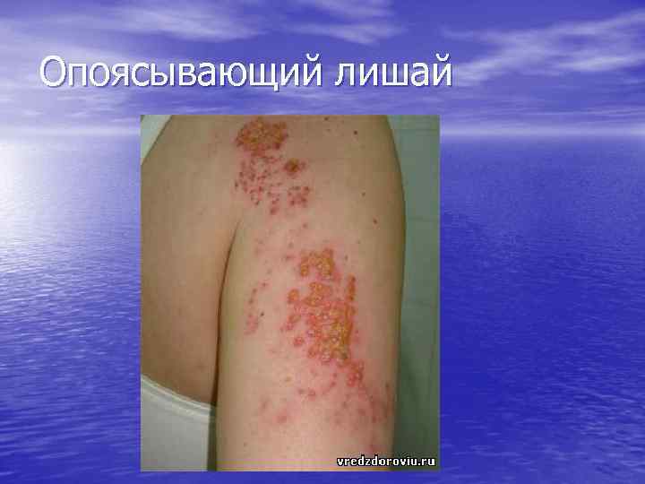 Опоясывающий лишай 