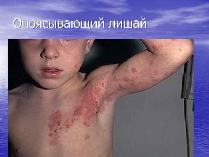 Опоясывающий лишай 