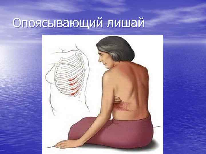 Опоясывающий лишай 