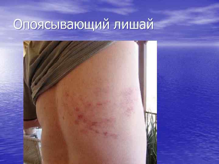 Опоясывающий лишай 