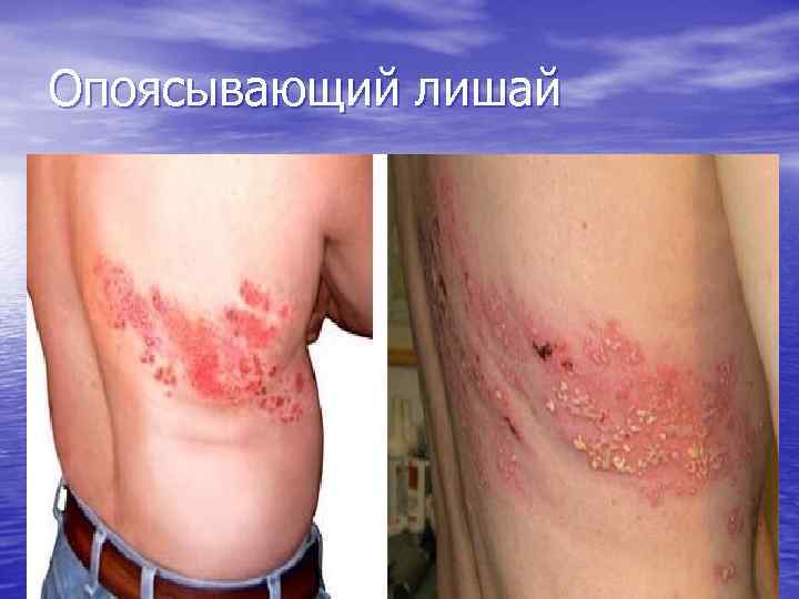 Опоясывающий лишай 