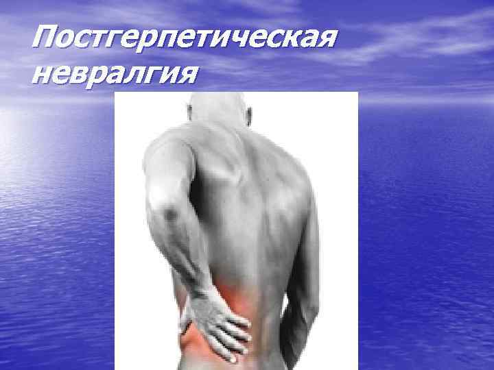 Постгерпетическая невралгия 