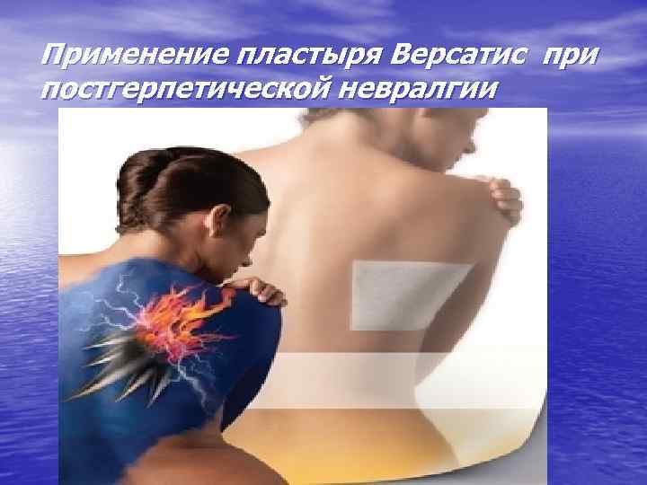Применение пластыря Версатис при постгерпетической невралгии 