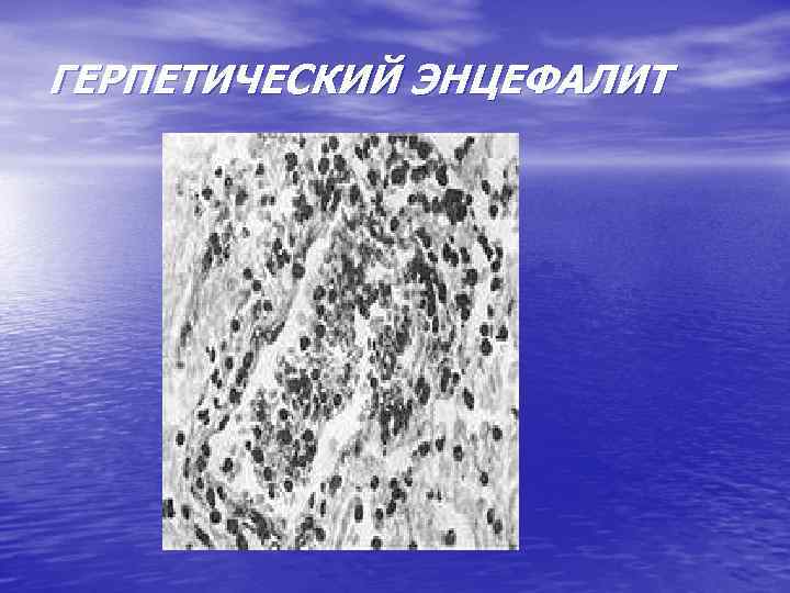 ГЕРПЕТИЧЕСКИЙ ЭНЦЕФАЛИТ 