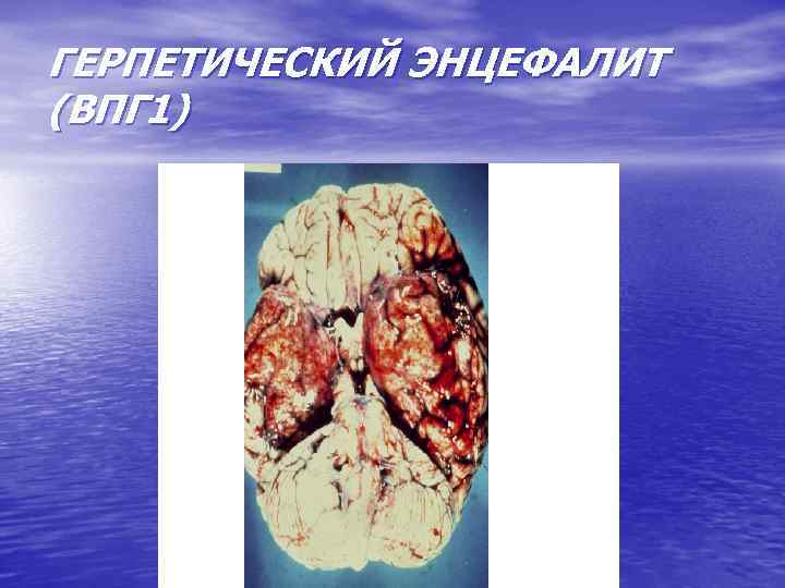 ГЕРПЕТИЧЕСКИЙ ЭНЦЕФАЛИТ (ВПГ 1) 