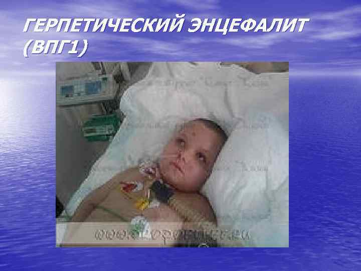 ГЕРПЕТИЧЕСКИЙ ЭНЦЕФАЛИТ (ВПГ 1) 