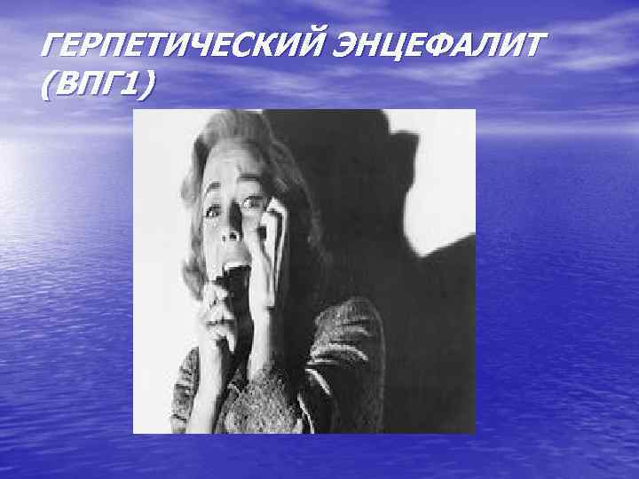 ГЕРПЕТИЧЕСКИЙ ЭНЦЕФАЛИТ (ВПГ 1) 