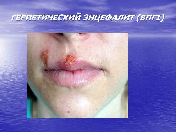 ГЕРПЕТИЧЕСКИЙ ЭНЦЕФАЛИТ (ВПГ 1) 