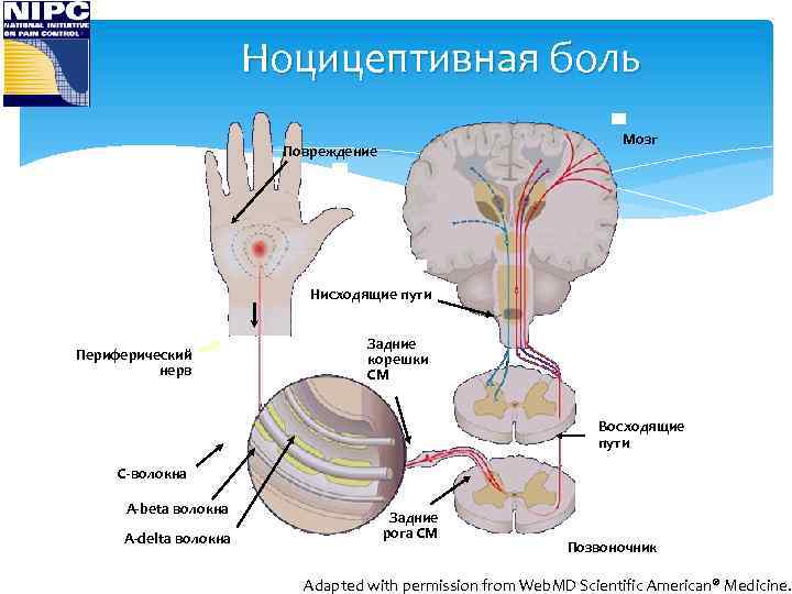 Ноцицептивная боль Мозг Повреждение Нисходящие пути Периферический нерв Задние корешки СМ Восходящие пути C-волокна