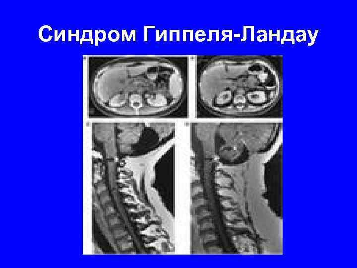 Синдром Гиппеля-Ландау 