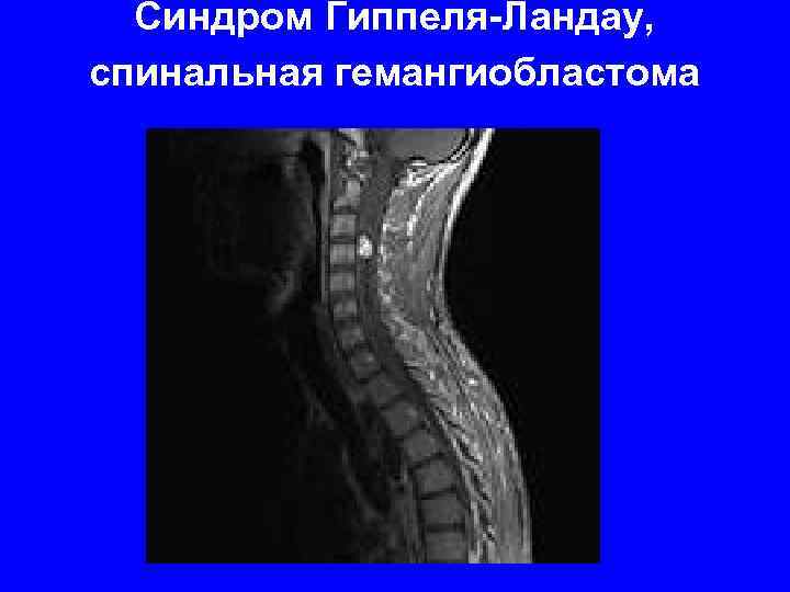 Синдром Гиппеля-Ландау, спинальная гемангиобластома 