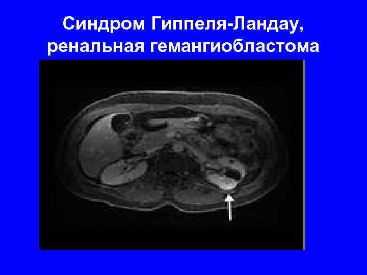 Синдром Гиппеля-Ландау, ренальная гемангиобластома 