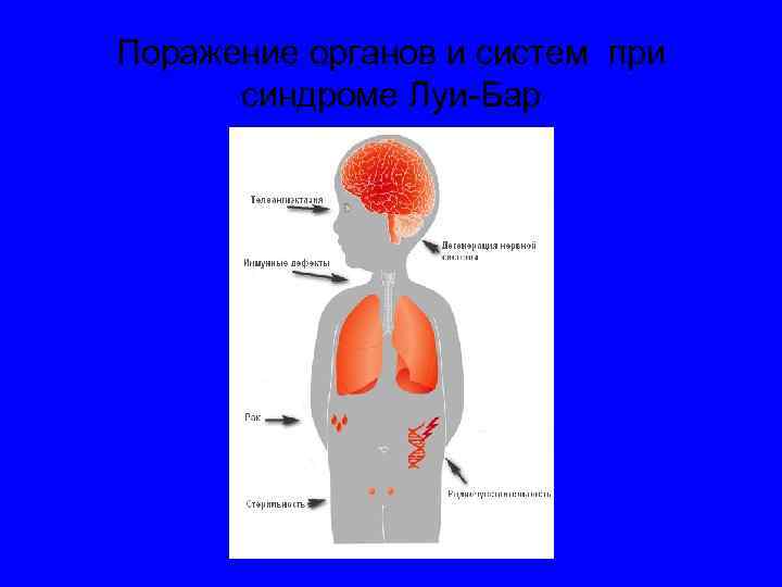 Поражение органов и систем при синдроме Луи-Бар 