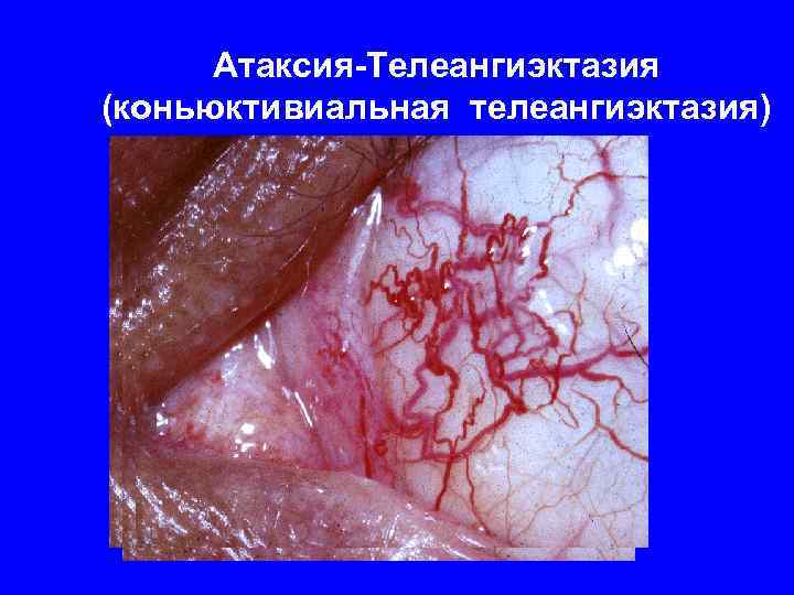 Атаксия-Телеангиэктазия (коньюктивиальная телеангиэктазия) 