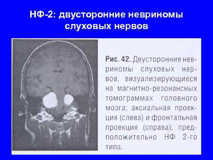 Невринома слухового нерва презентация