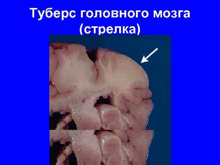 Туберс головного мозга (стрелка) 