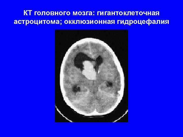 КТ головного мозга: гигантоклеточная астроцитома; окклюзионная гидроцефалия 