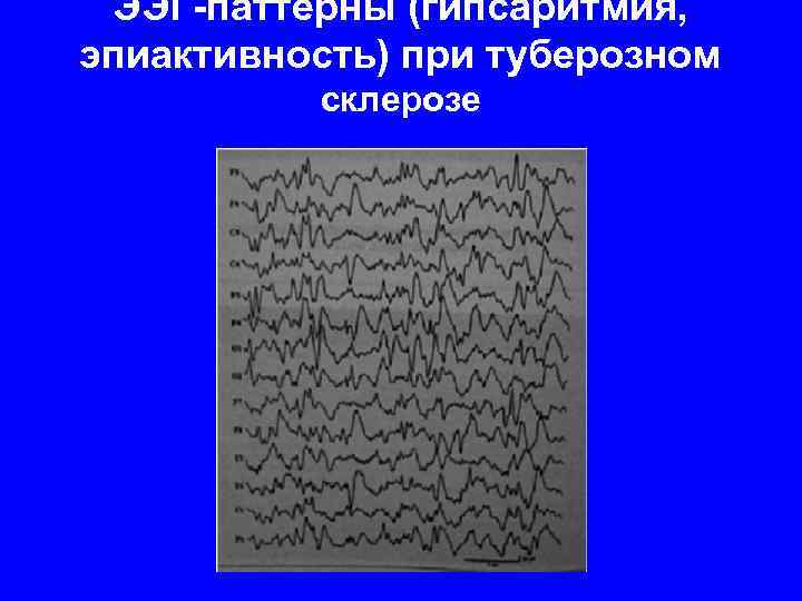 Эпиактивность. Гипсаритмия на ЭЭГ. Гипсаритмия паттерны на ЭЭГ. Эпиактивность на ЭЭГ. Модифицированная гипсаритмия.