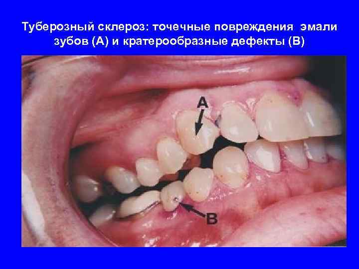 Туберозный склероз: точечные повреждения эмали зубов (А) и кратерообразные дефекты (В) 