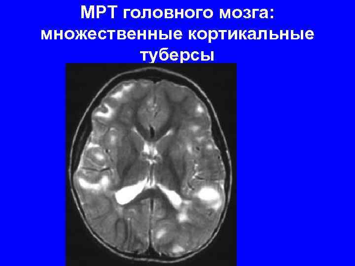 МРТ головного мозга: множественные кортикальные туберсы 