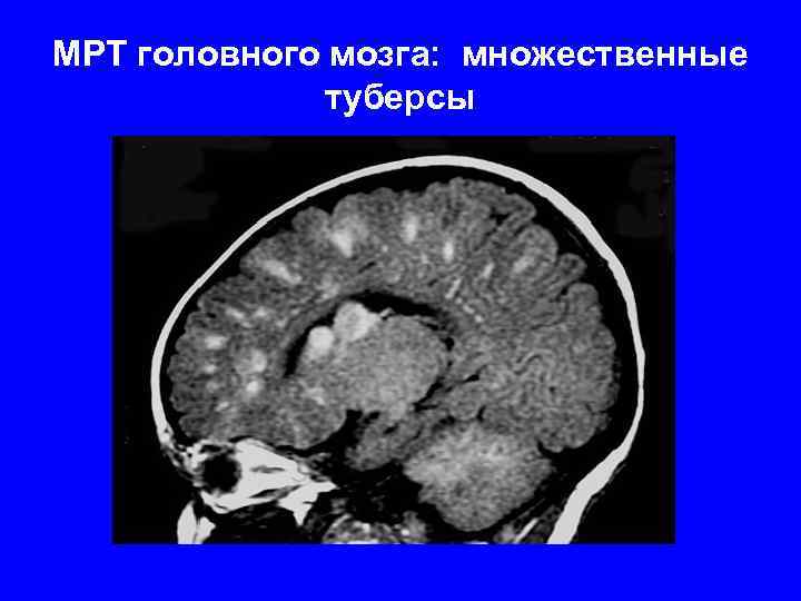 МРТ головного мозга: множественные туберсы 