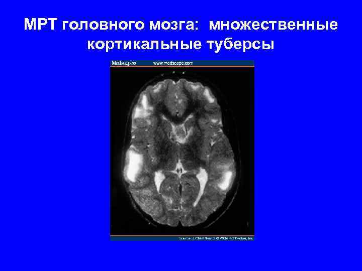 МРТ головного мозга: множественные кортикальные туберсы 