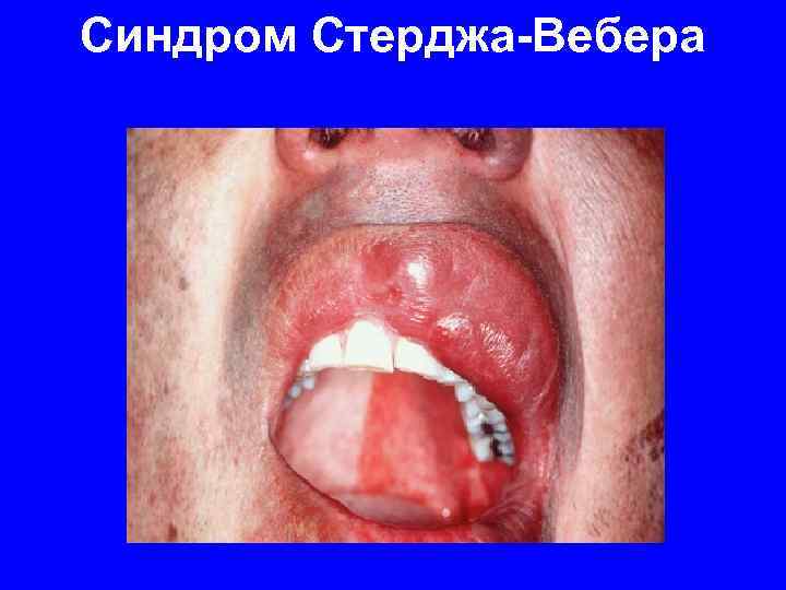 Синдром Стерджа-Вебера 