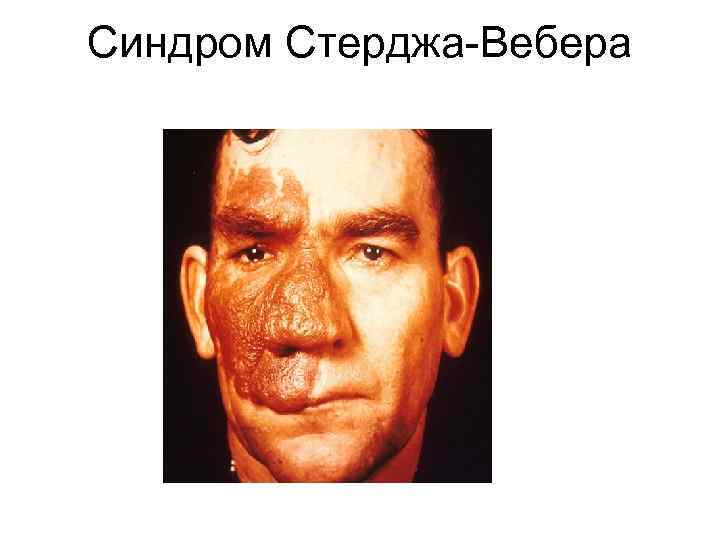 Синдром Стерджа-Вебера 