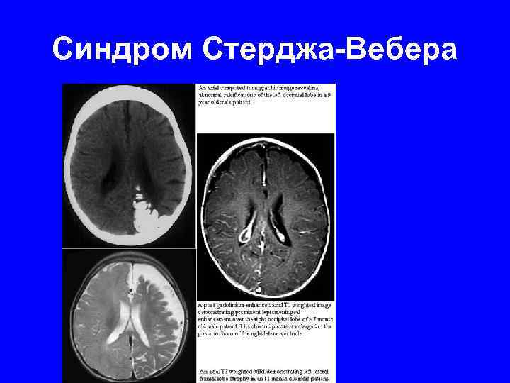 Синдром Стерджа-Вебера 