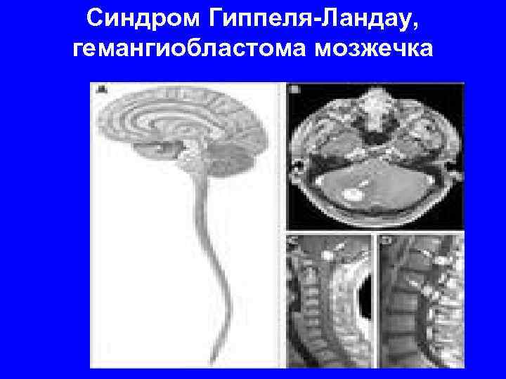 Синдром Гиппеля-Ландау, гемангиобластома мозжечка 