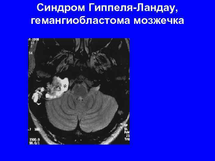 Синдром Гиппеля-Ландау, гемангиобластома мозжечка 