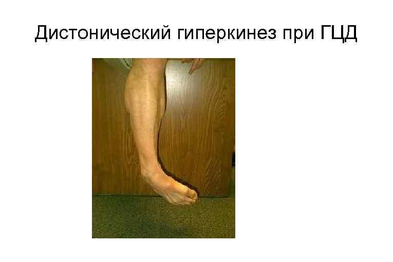 Дистонический гиперкинез при ГЦД 