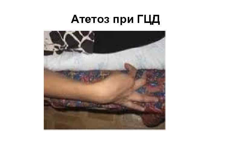 Атетоз при ГЦД 