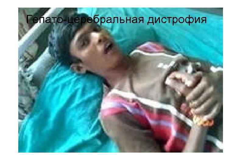 Гепато-церебральная дистрофия 
