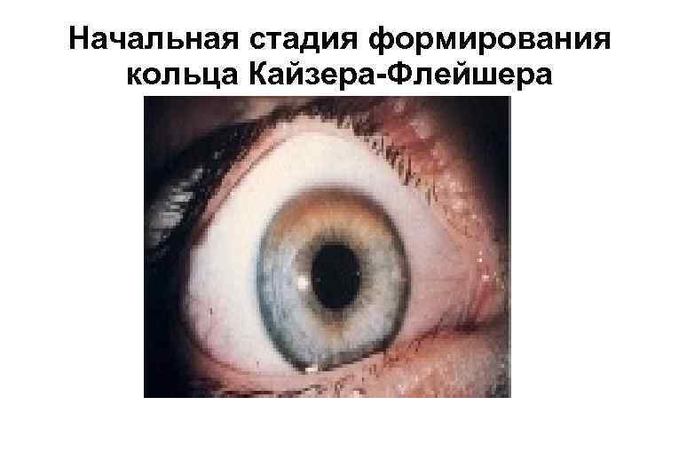 Начальная стадия формирования кольца Кайзера-Флейшера 