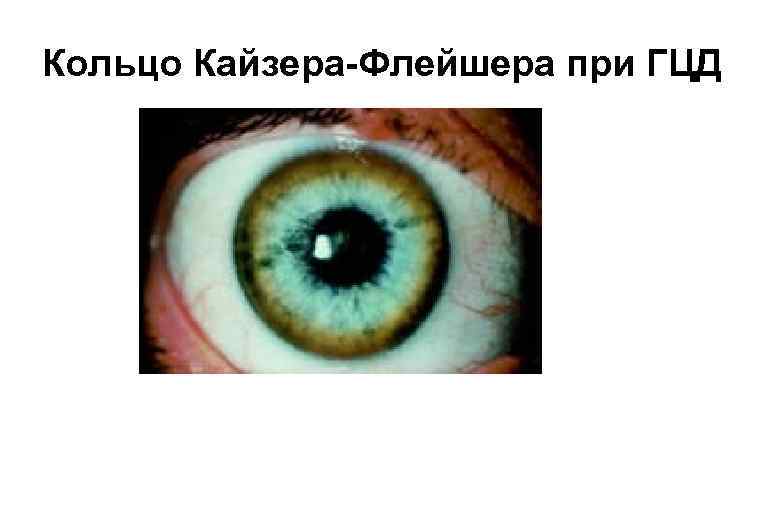 Кольцо Кайзера-Флейшера при ГЦД 